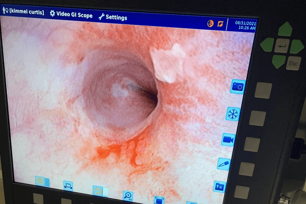 Endoscopy Endoscopy
